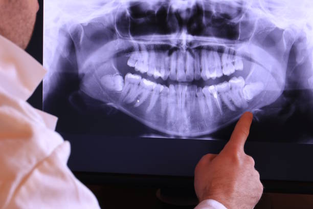 Best Emergency Wisdom Teeth Removal in Gas City, IN